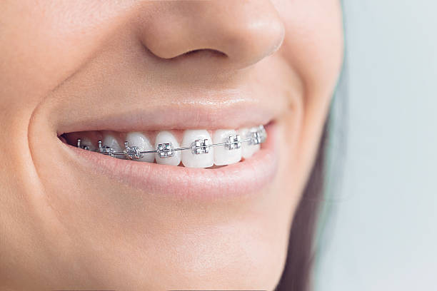 Dental Bonding in Diamond Bar, CA
